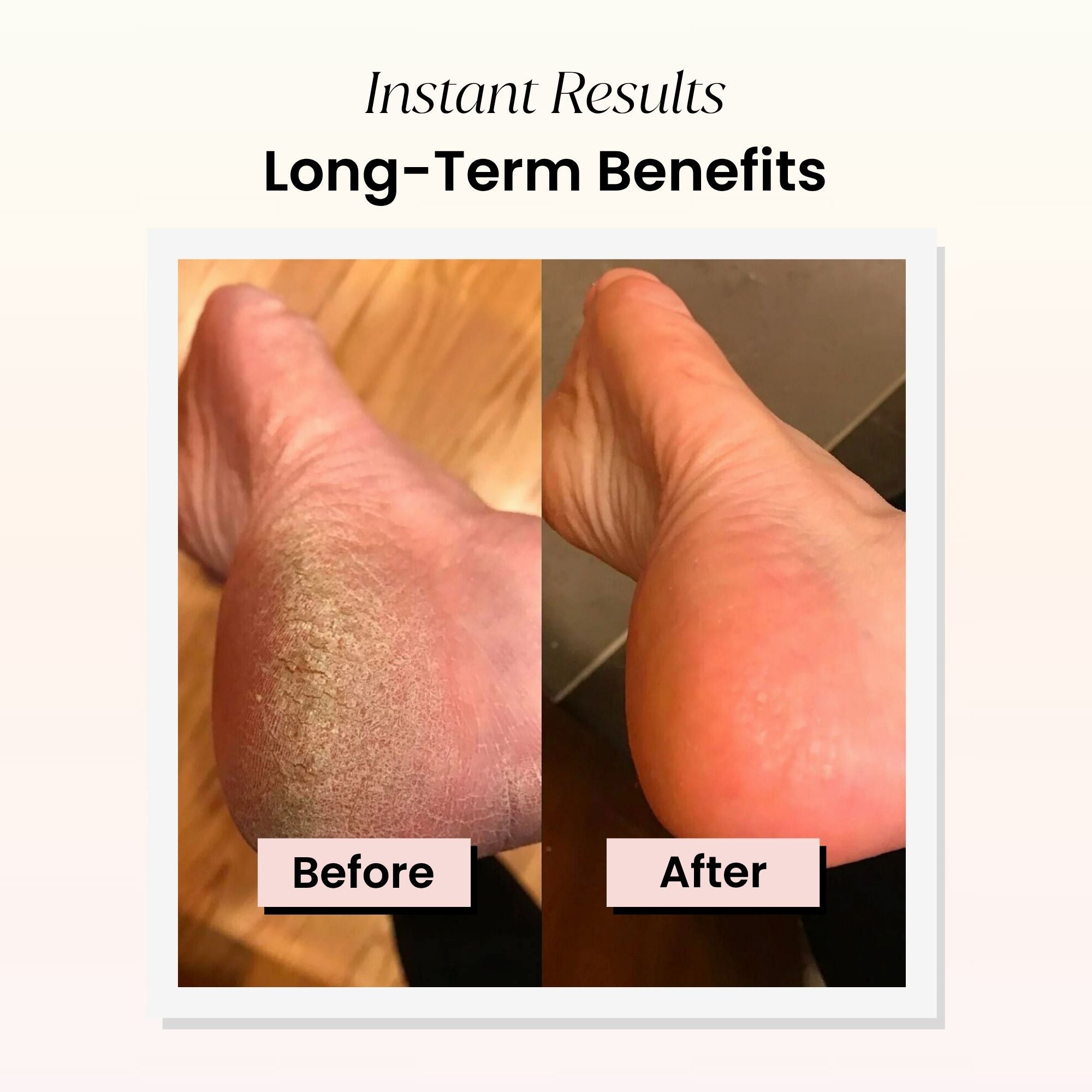 Pedicuure™ Electric Foot Callus Remover