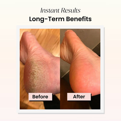 Pedicuure™ Electric Foot Callus Remover