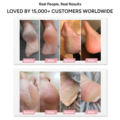 Pedicuure™ Electric Foot Callus Remover