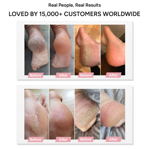 Pedicuure™ Electric Foot Callus Remover